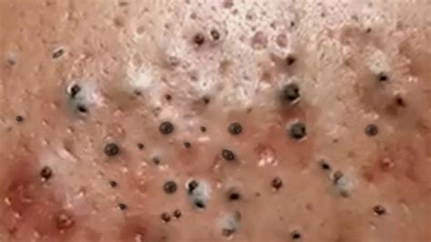 biggest popping pimples videos|severe infected blackhead removal videos 2023.